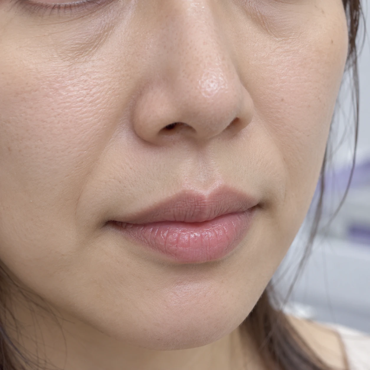 Close-up of smile folds