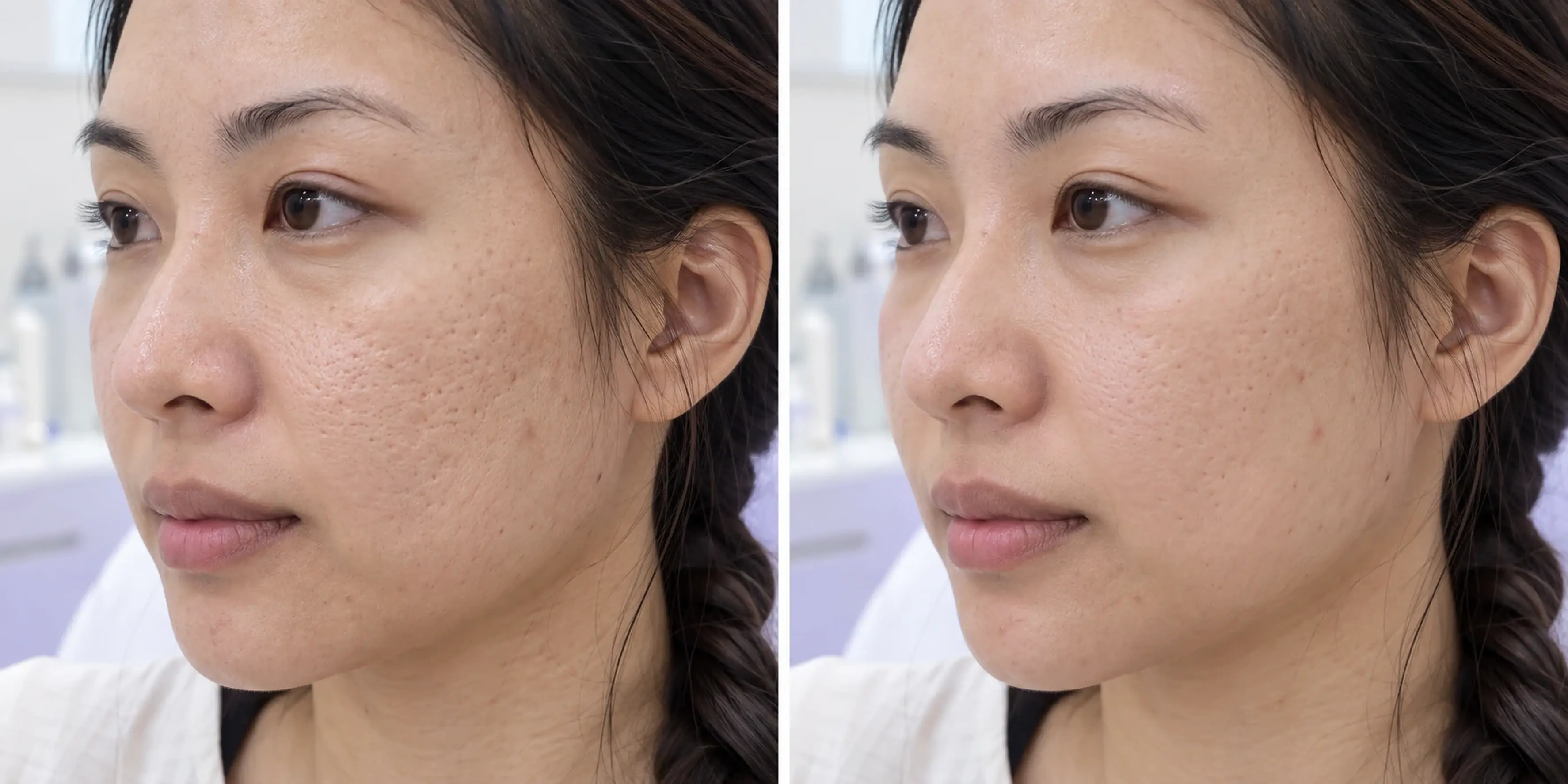 Simulated subtle skin texture change in an adult face