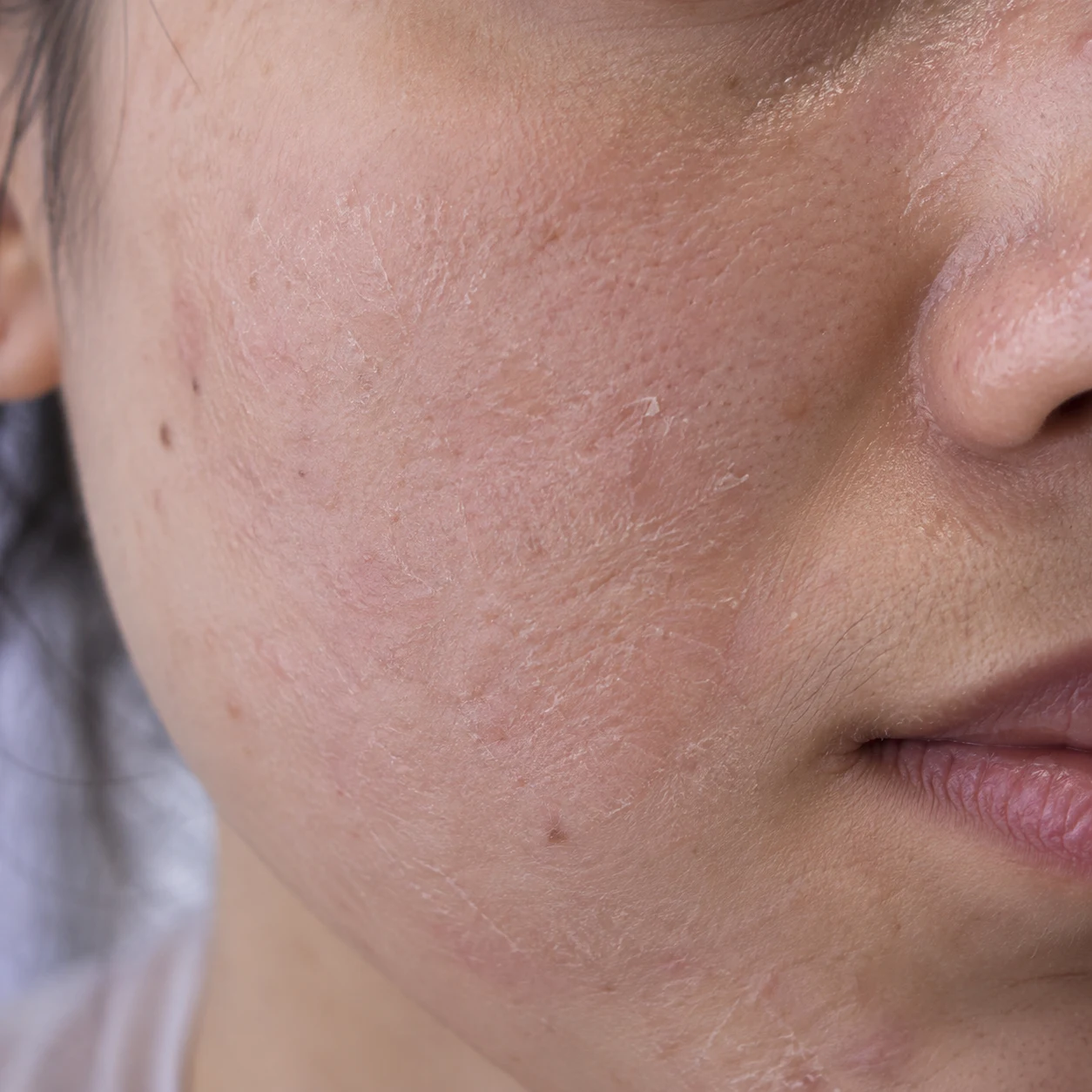 Close-up of dry cheek