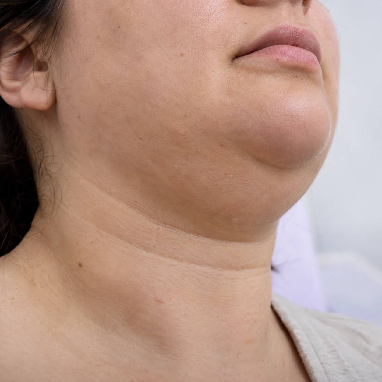 Close-up of submental fullness