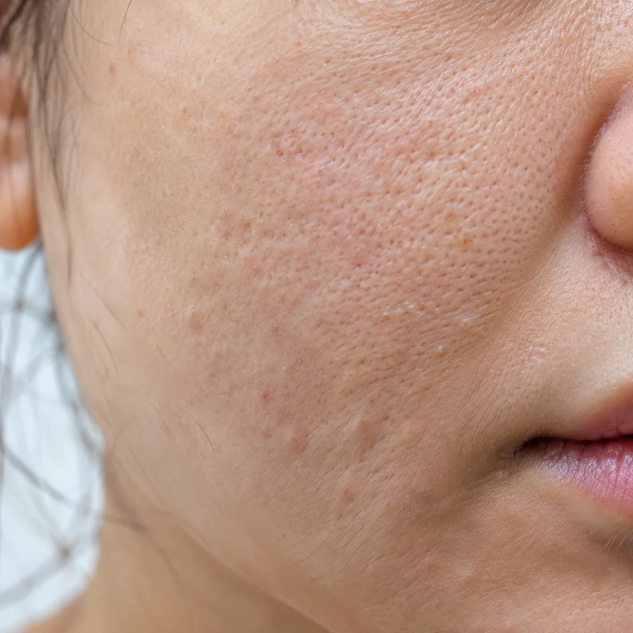 Close-up of puffy lower cheek