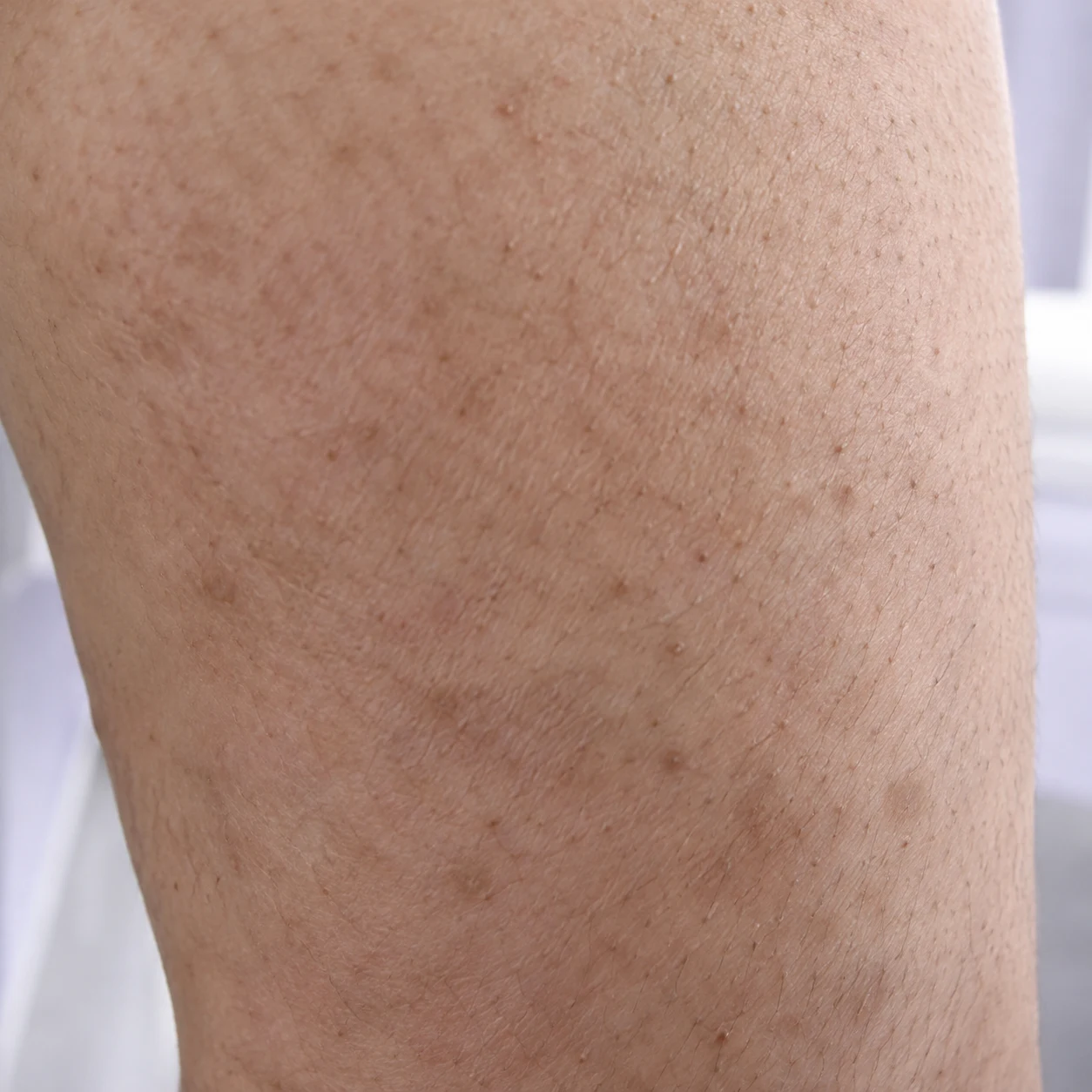 Close-up of uneven thigh texture