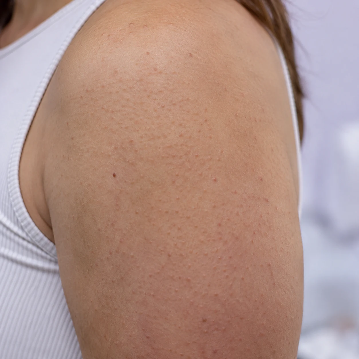 Close-up of upper-arm texture