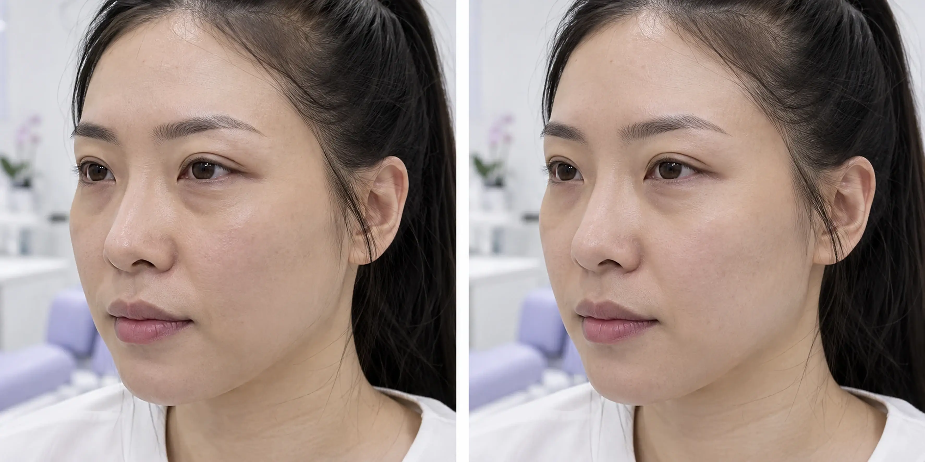 Simulated subtle local fullness and skin texture change in an adult face