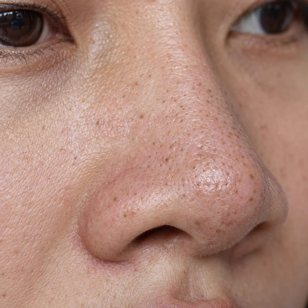 Close-up of congested nose