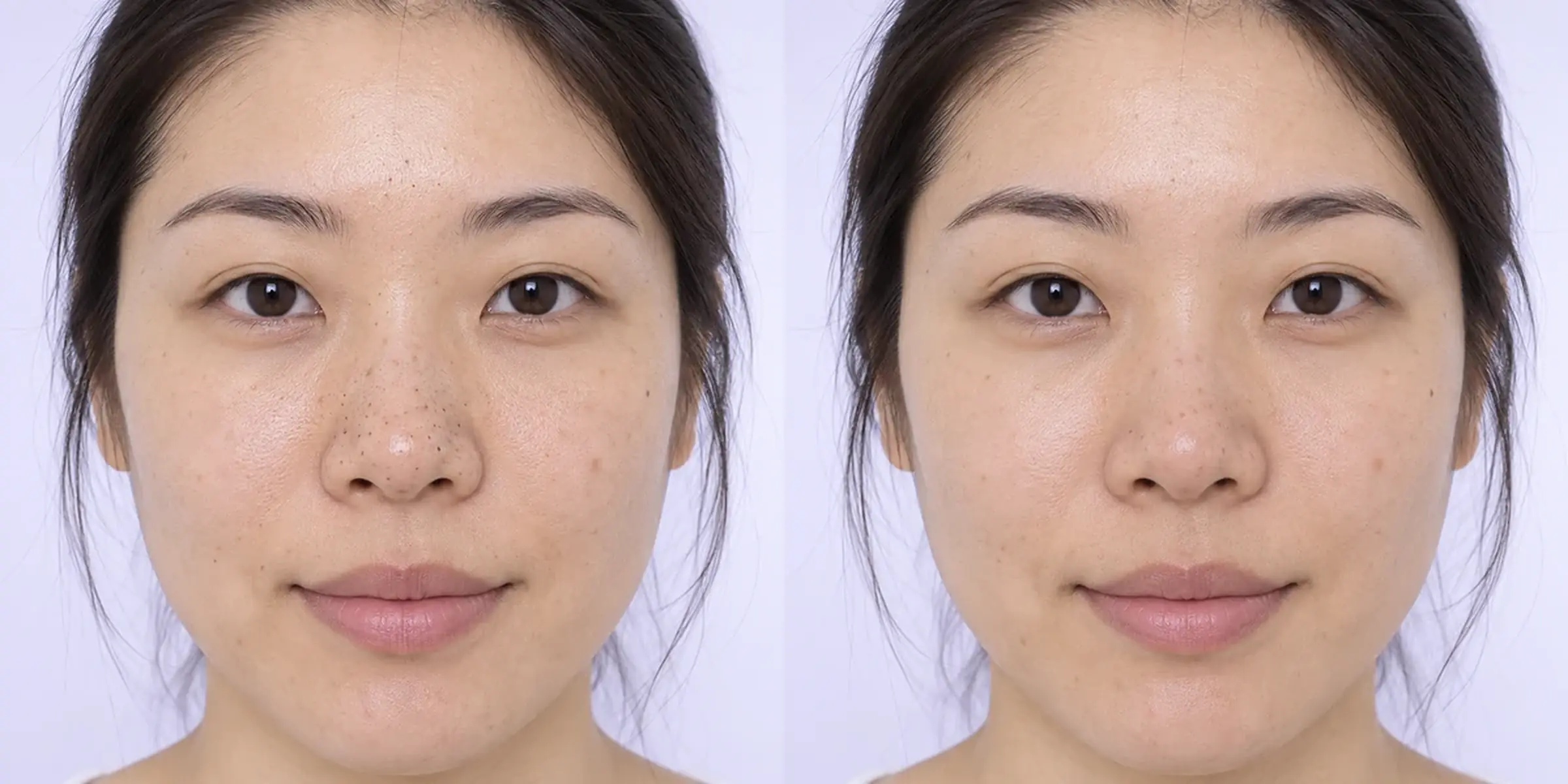 Simulated subtle selected comedonal congestion change in an adult face
