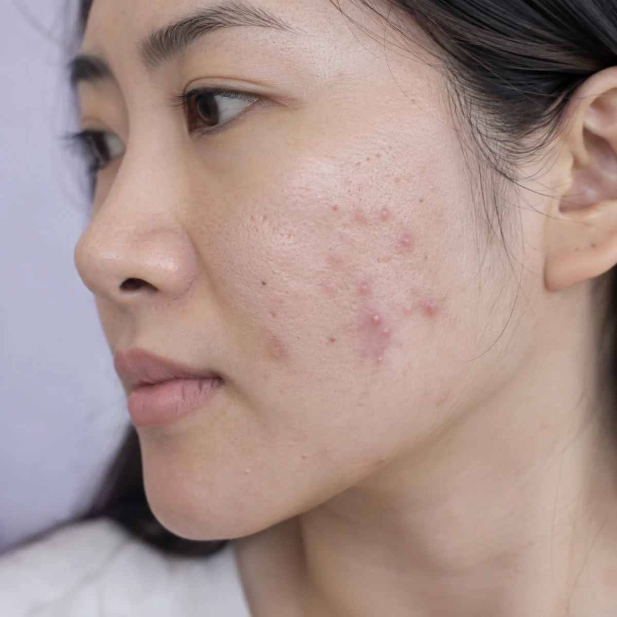 Close-up of inflamed acne