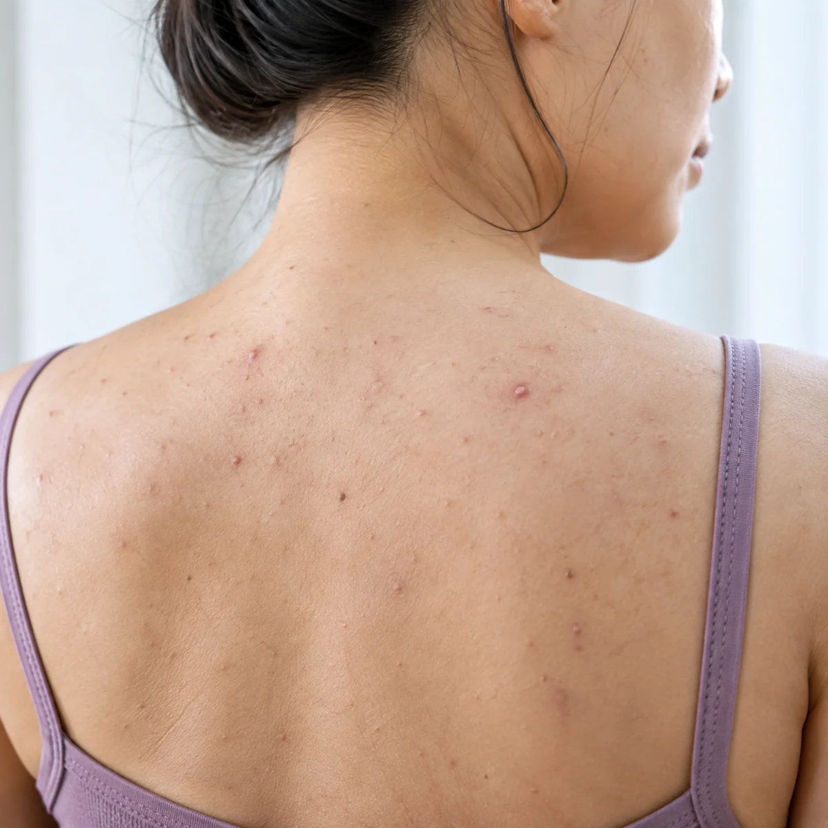 Close-up of chest and back acne