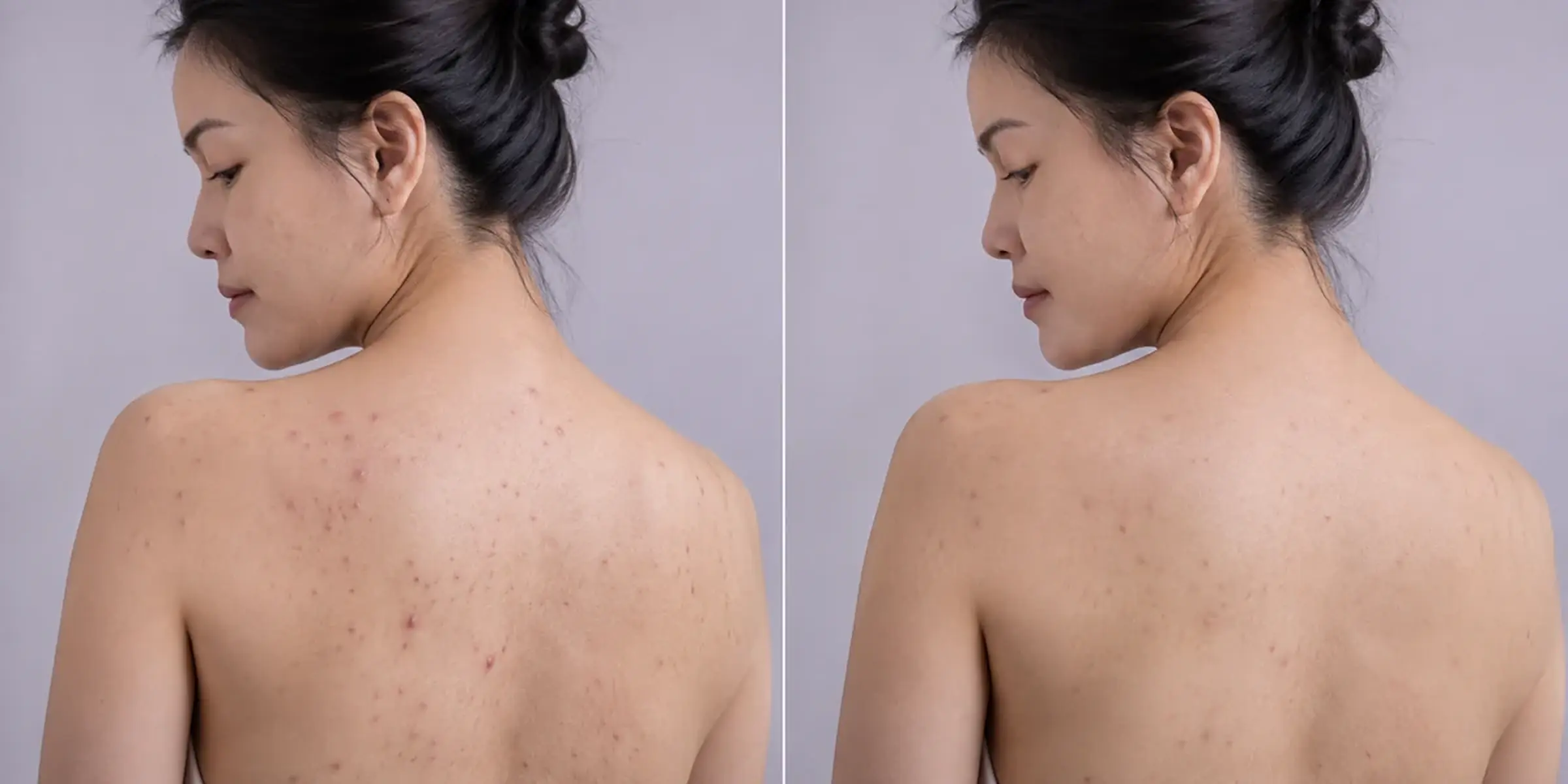 More inflamed lesions on an adult patient’s skin