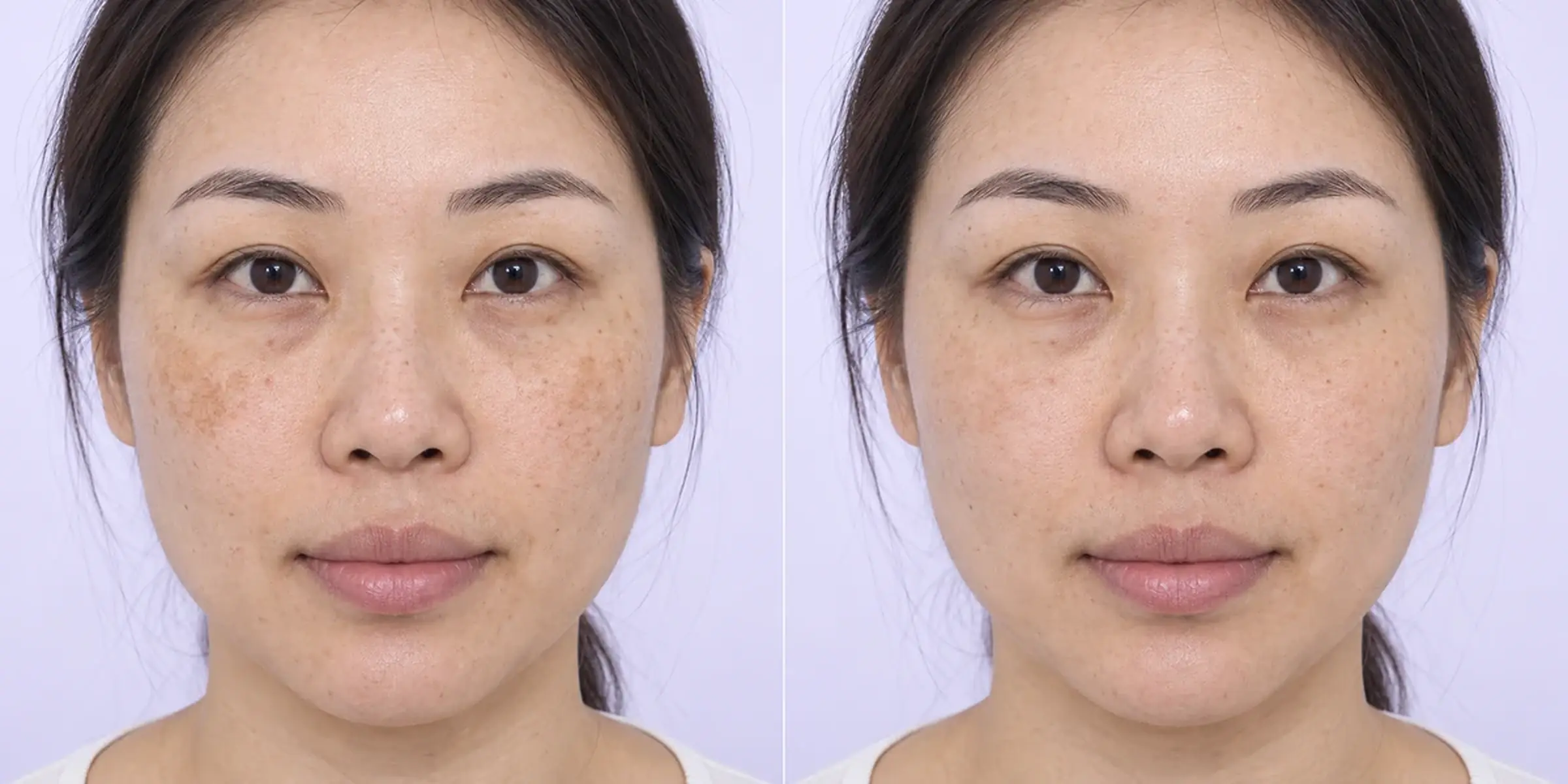 Simulated subtle patchy facial pigmentation change in an adult face