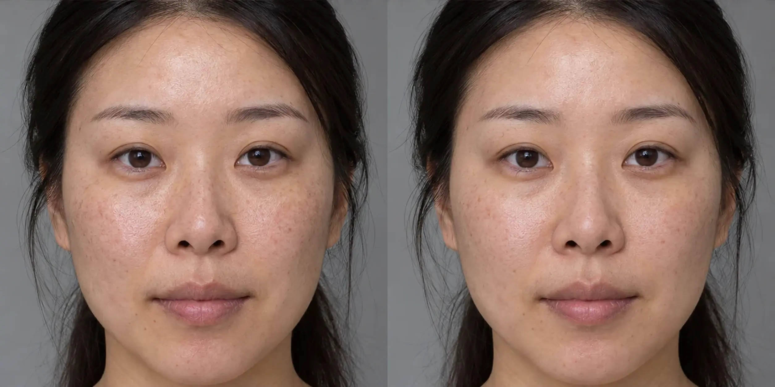 More visible superficial uneven tone and surface dullness on an adult patient’s skin