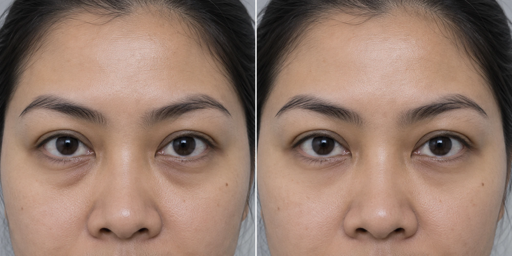 Lower-lid fullness and shadow in an adult face