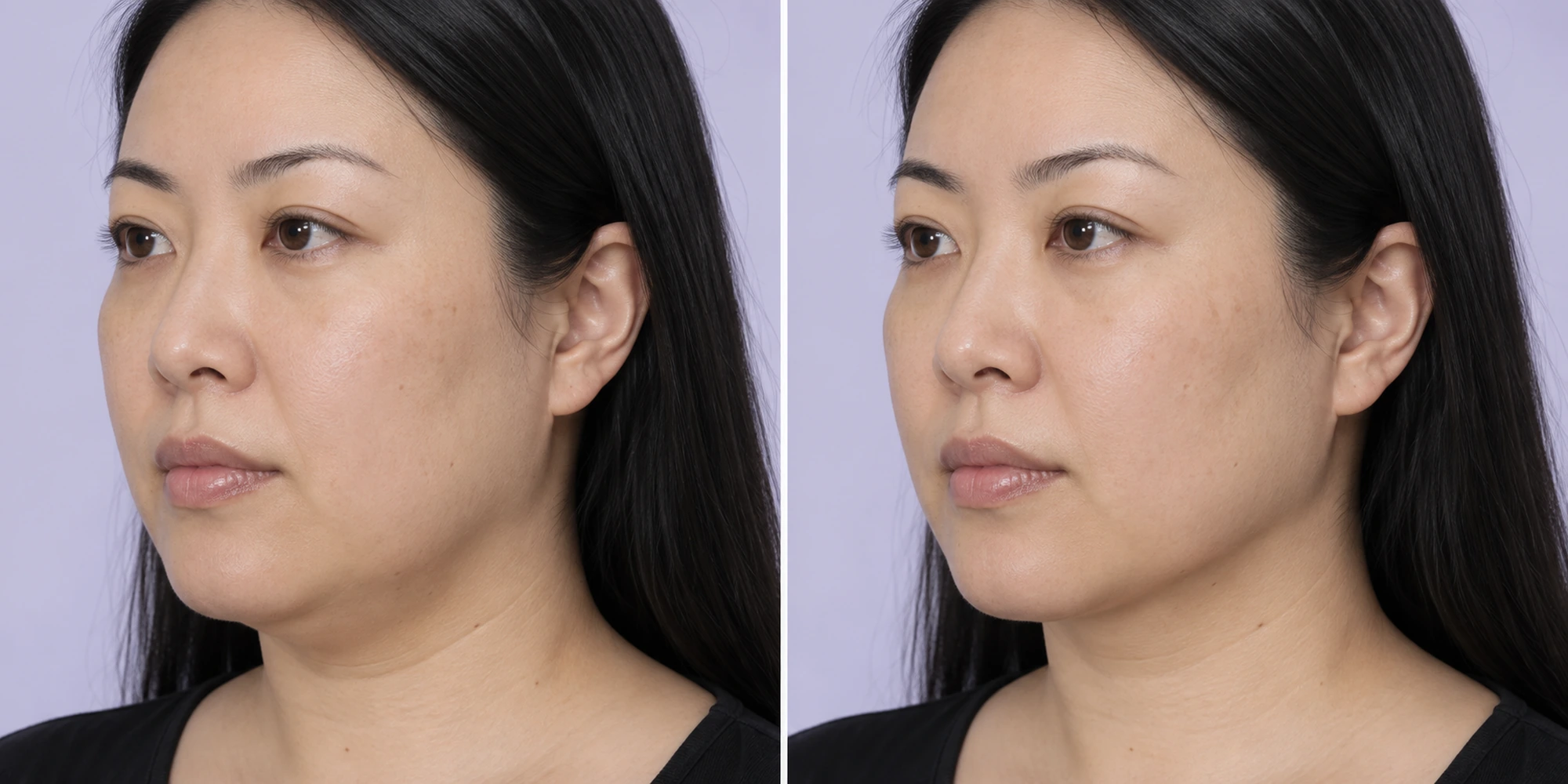 Simulated subtle selected facial laxity and contour support change in an adult face