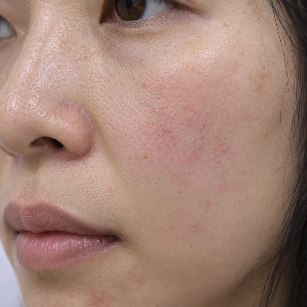 Close-up of visible facial vessels