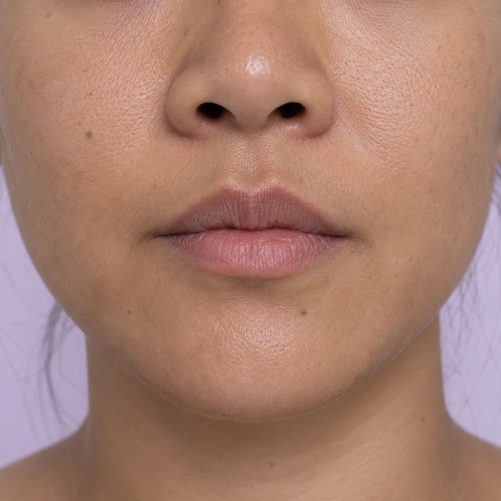 Close-up of subtle lip-volume concern