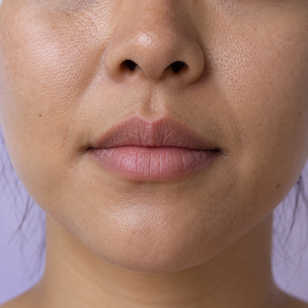 Close-up of perioral fine lines