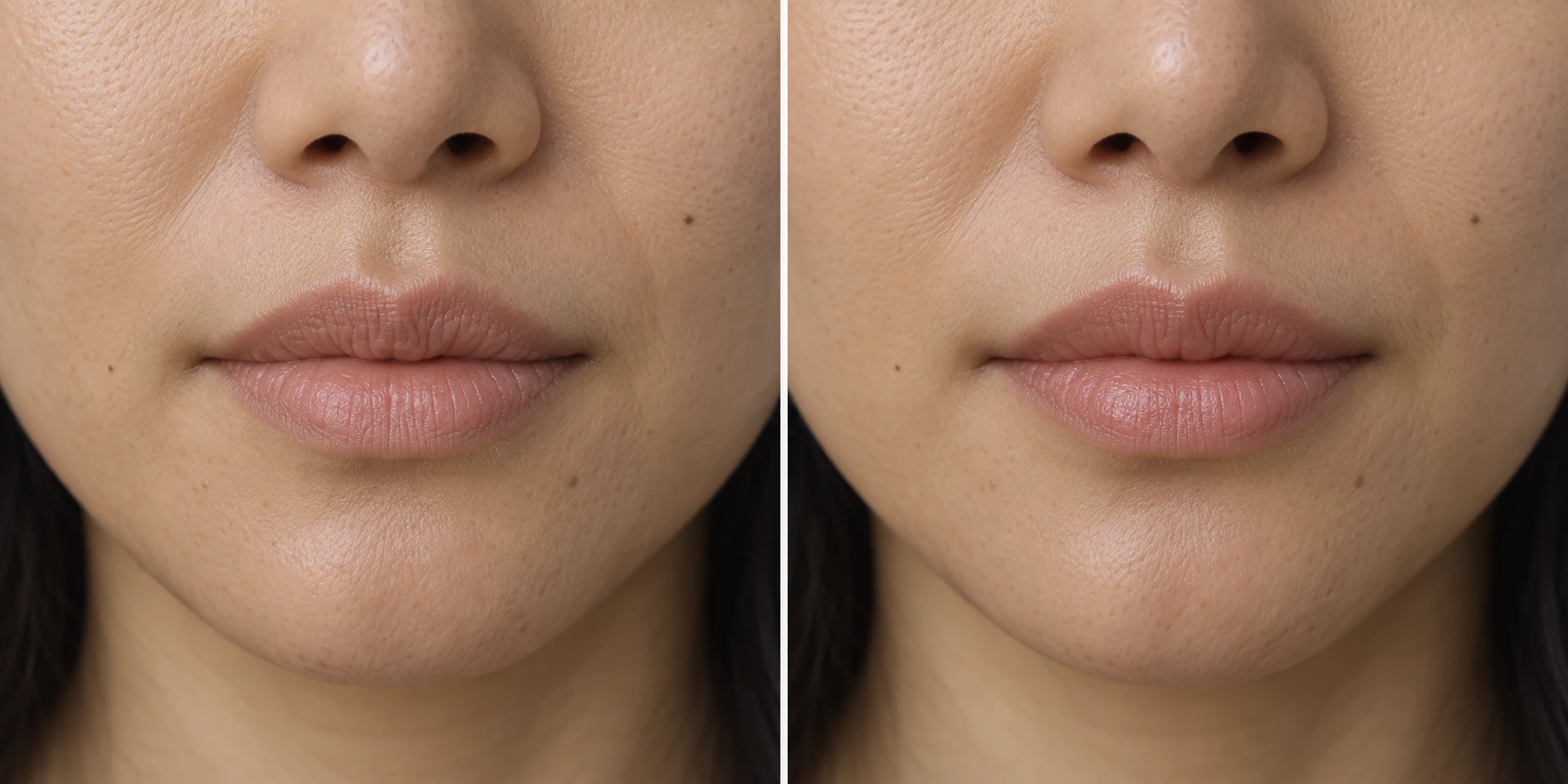 Simulated subtle lip surface, subtle definition and fine perioral lines change in an adult face
