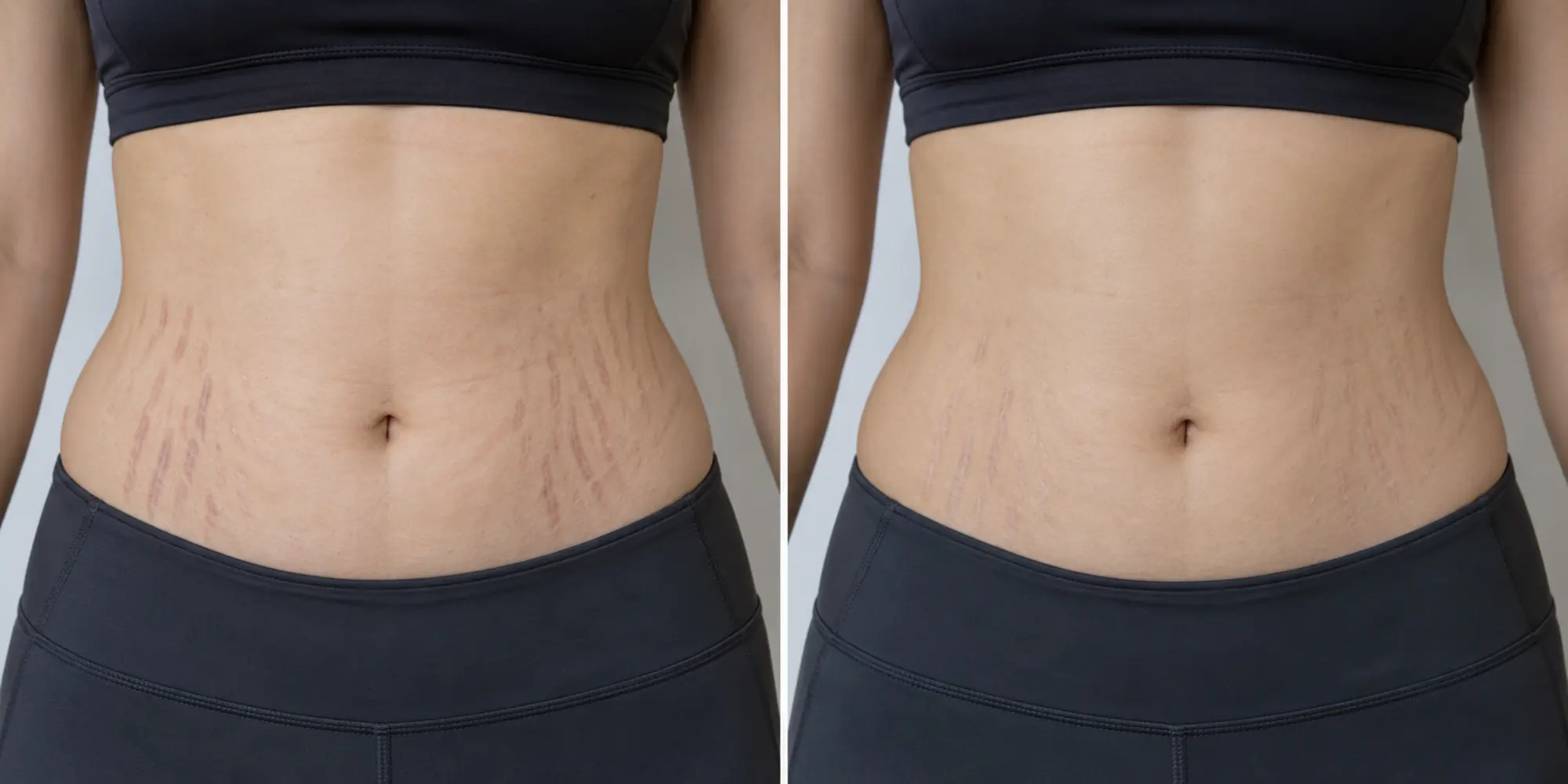 Simulated subtle abdominal striae colour, width and texture change in the matched assessment area