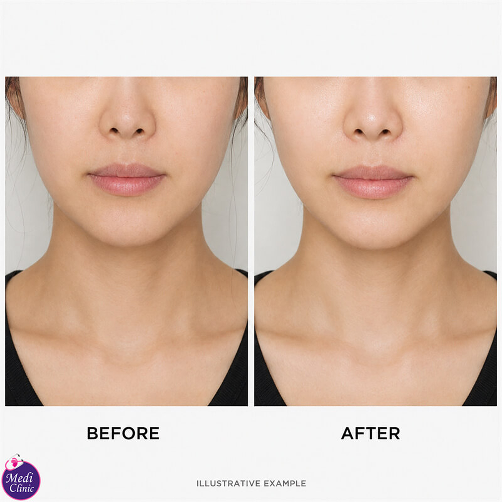 Skin Booster Treatment — service illustration