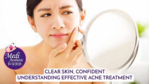 Clear Skin, Confident You Understanding Effective Acne Treatment
