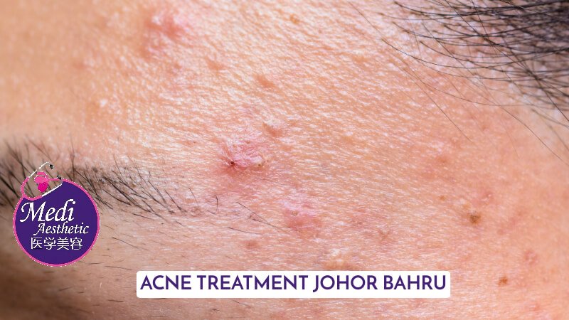 Combat Acne Breakouts Discover The Best Acne Treatment Methods Johor Bahru