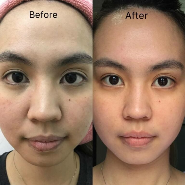 Before After Result Certified Medi Clinic JB Bahru JB 1