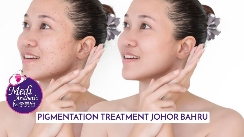 Revitalize Your Complexion Exploring Pigmentation Treatment Methods Malaysia