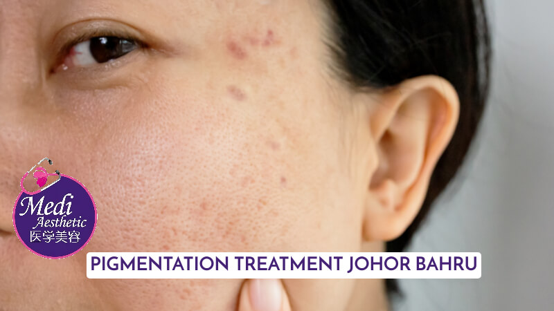 Say Goodbye To Pigmentation Issues Effective Pigmentation Treatment Options Johor Bahru