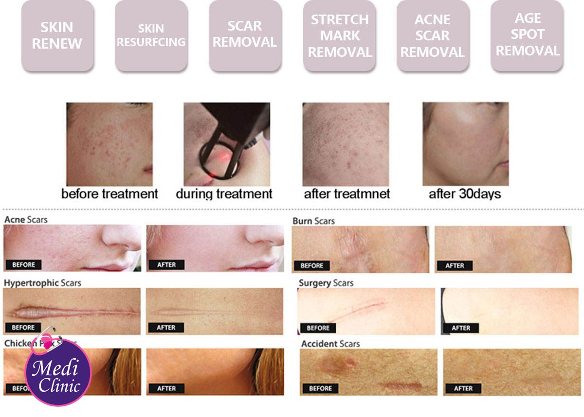 Before and after CO2 laser skin resurfacing in JB by Medi Clinic for Singaporean patients