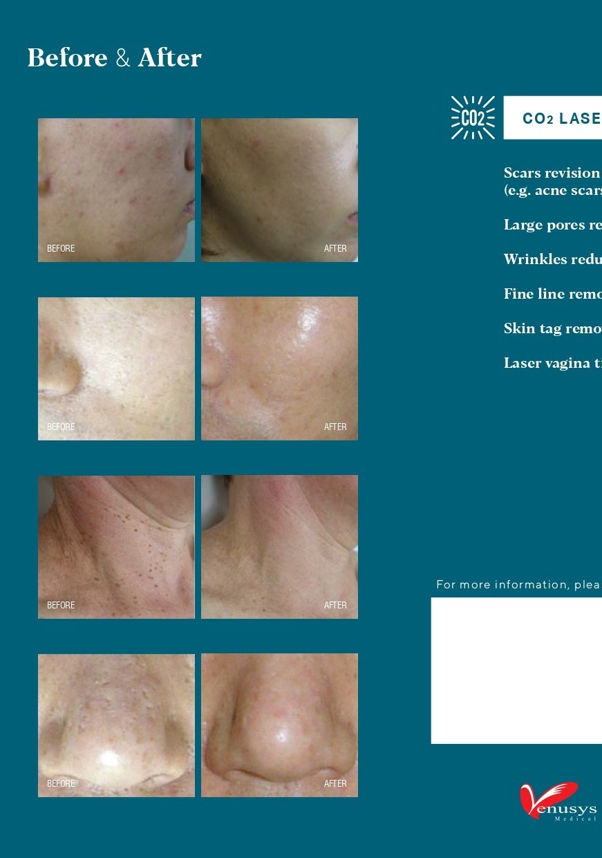 CO2 fractional laser consultation room at Medi Clinic Johor Bahru, popular among Singaporeans