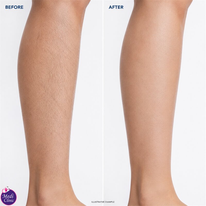 Hair-removal consultation for Singapore patients visiting JB JB SG Hair-removal consultation for Singapore patients visiting JB JB SG