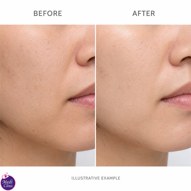 Skin assessment for uneven-looking tone in Johor Bahru JB SG Skin assessment for uneven-looking tone in Johor Bahru JB SG